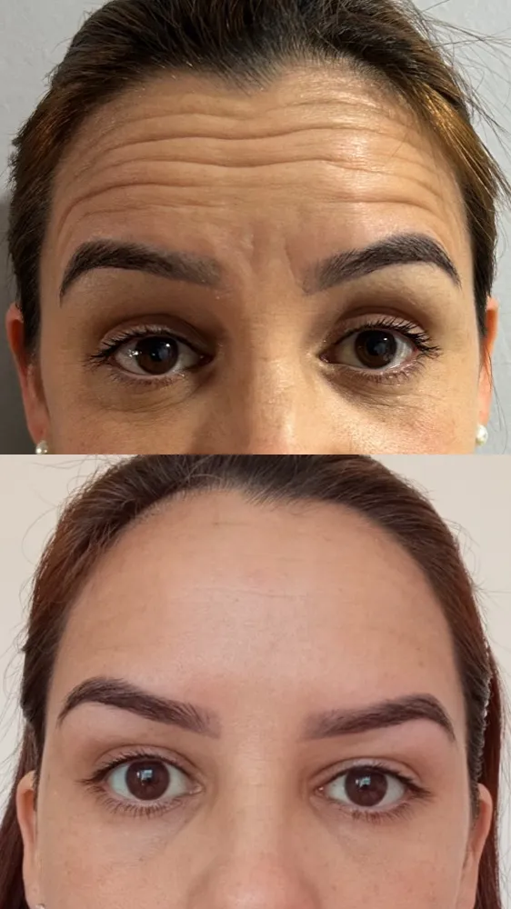 Registro fotográfico do dia 1 e do dia 78 de um protocolo de harmonização facial, caso 01