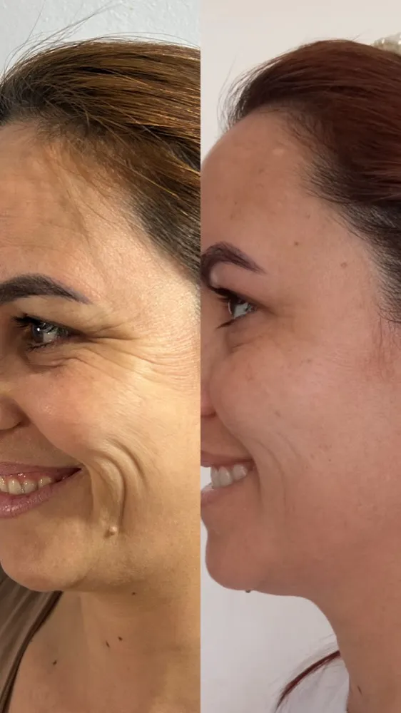 Registro fotográfico do dia 1 e do dia 78 de um protocolo de harmonização facial, caso 02