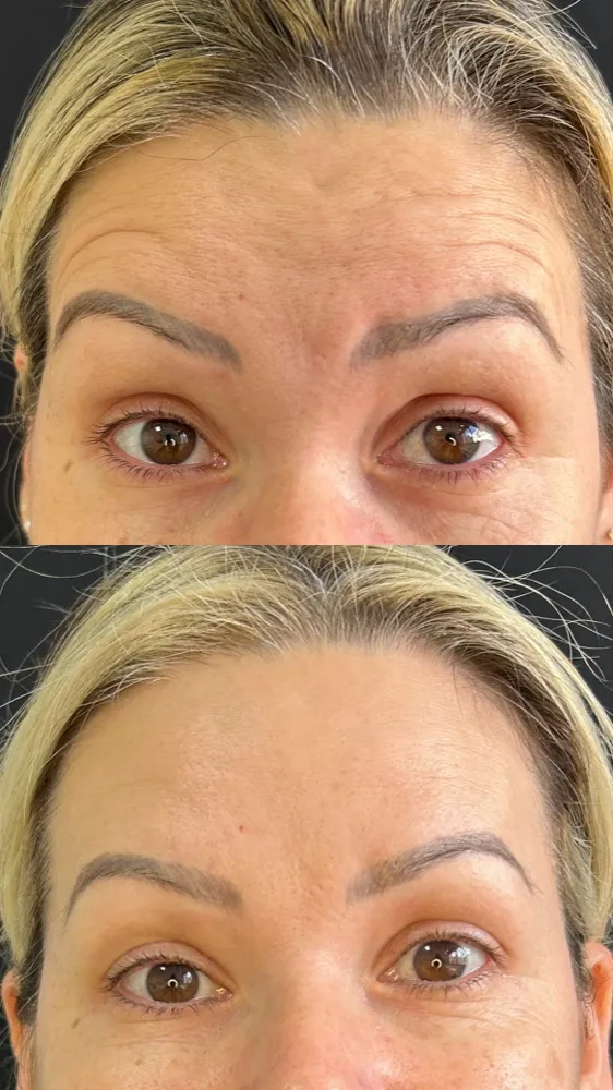 Registro fotográfico do dia 1 e do dia 78 de um protocolo de harmonização facial, caso 03
