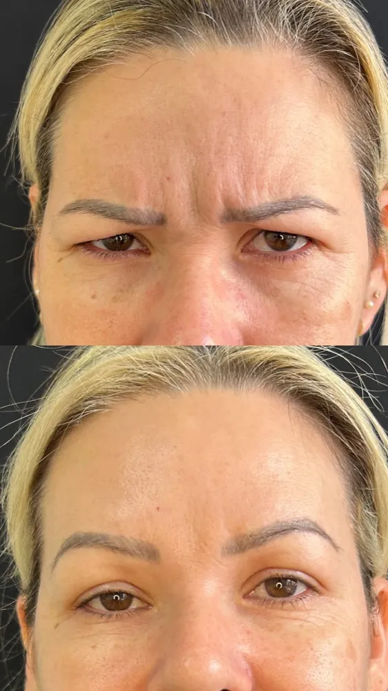 Registro fotográfico do dia 1 e do dia 78 de um protocolo de harmonização facial, caso 04
