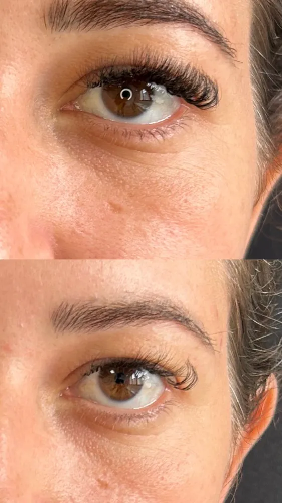 Registro fotográfico do dia 1 e do dia 78 de um protocolo de harmonização facial, caso 05