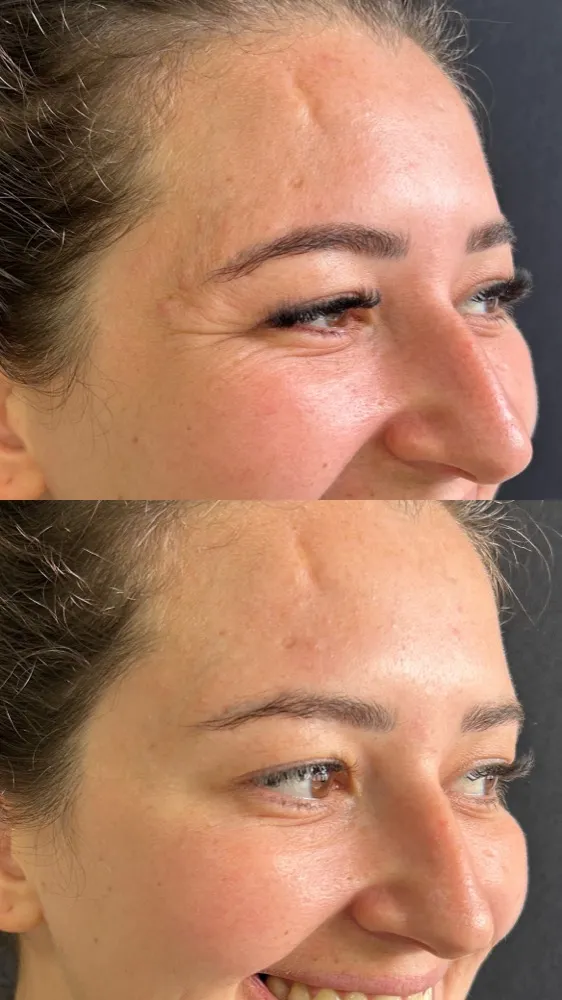 Registro fotográfico do dia 1 e do dia 78 de um protocolo de harmonização facial, caso 06