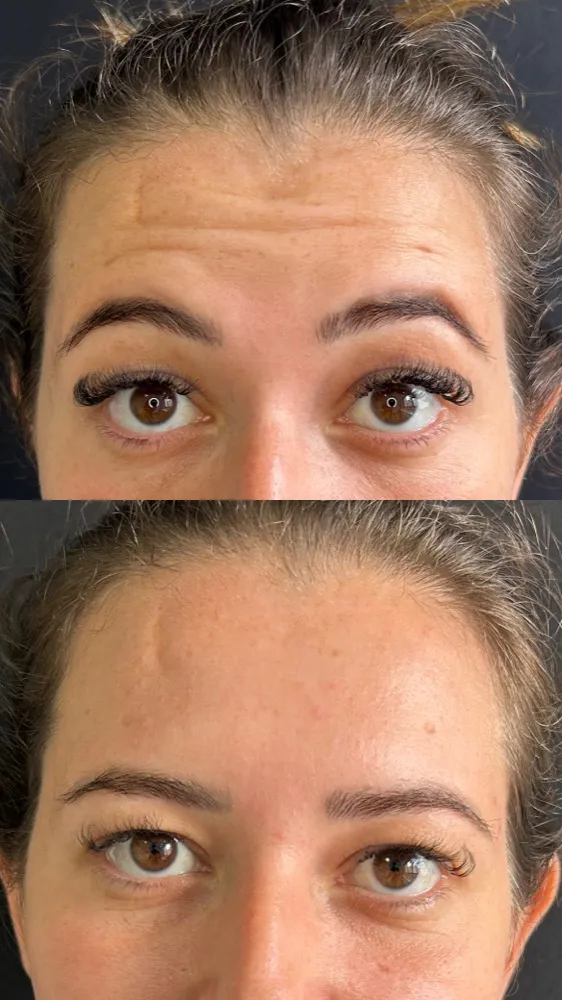 Registro fotográfico do dia 1 e do dia 78 de um protocolo de harmonização facial, caso 07