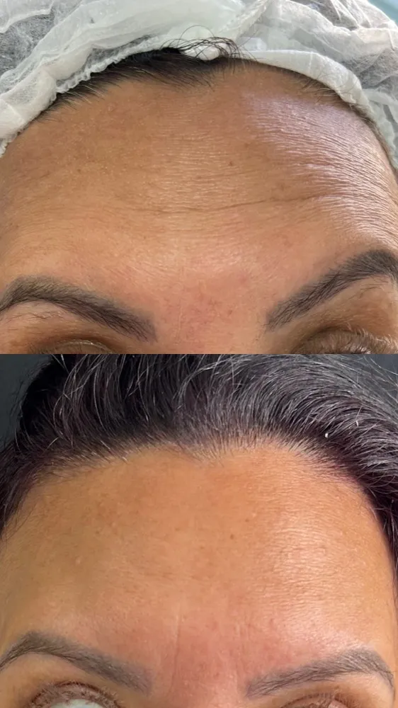 Registro fotográfico do dia 1 e do dia 78 de um protocolo de harmonização facial, caso 08