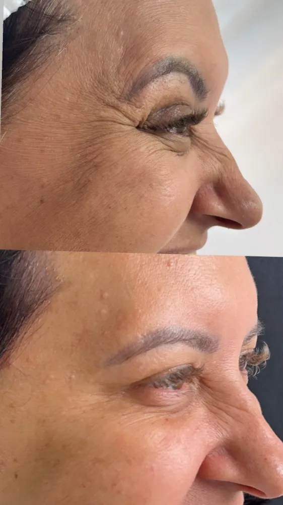 Registro fotográfico do dia 1 e do dia 78 de um protocolo de harmonização facial, caso 09