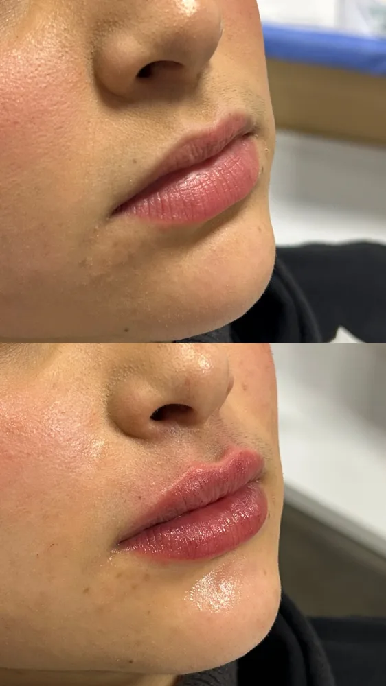 Registro fotográfico do dia 1 e do dia 78 de um protocolo de harmonização facial, caso 10