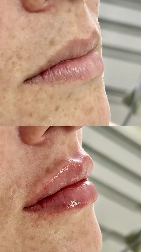 Registro fotográfico do dia 1 e do dia 78 de um protocolo de harmonização facial, caso 11