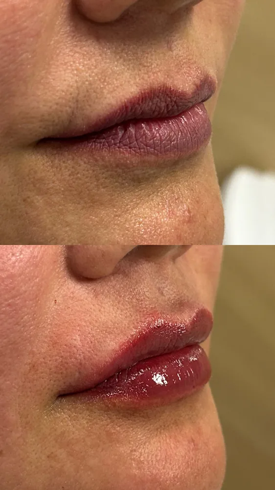Registro fotográfico do dia 1 e do dia 78 de um protocolo de harmonização facial, caso 12