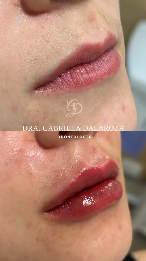 Registro fotográfico do dia 1 e do dia 78 de um protocolo de harmonização facial, caso 13